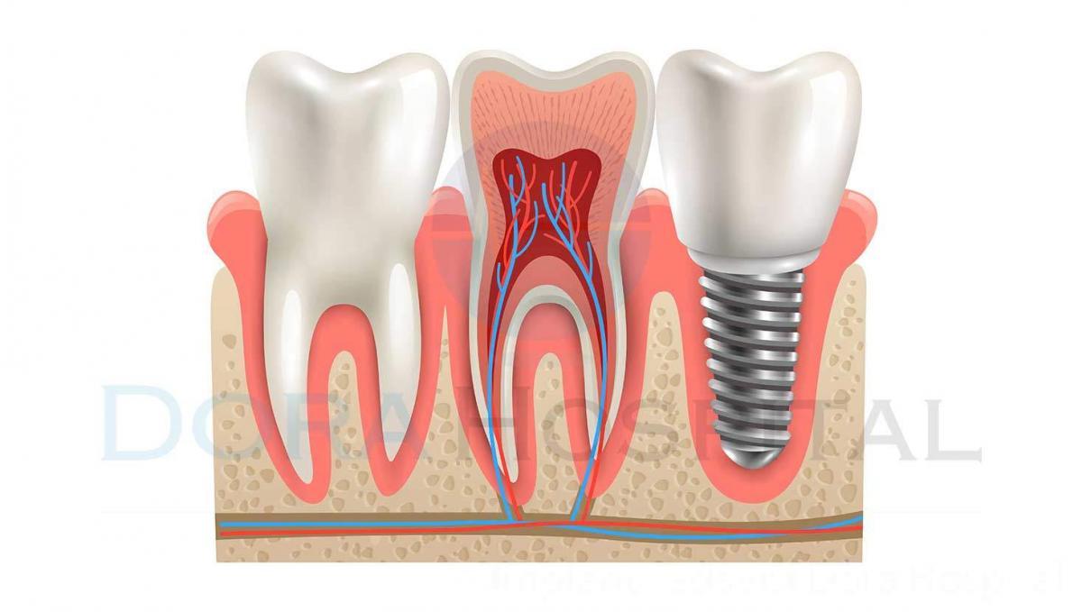 İmplant Tedavisi Dora Hospital