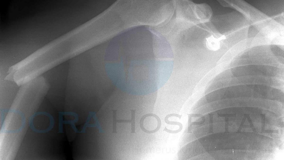 Humerus Kırığı