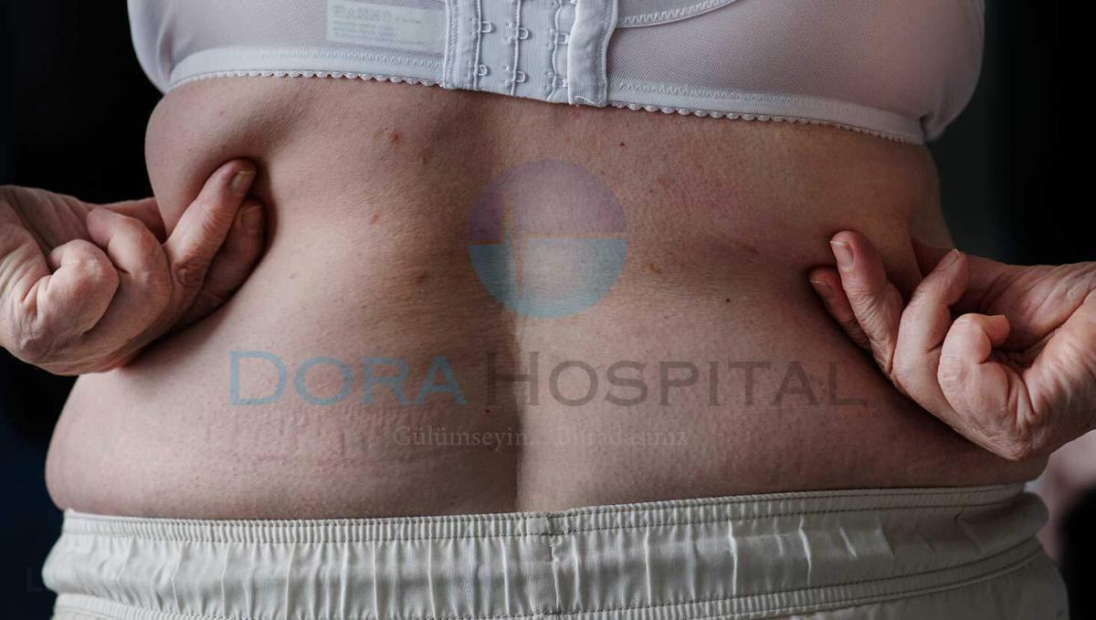 Liposuction Fiyatları
