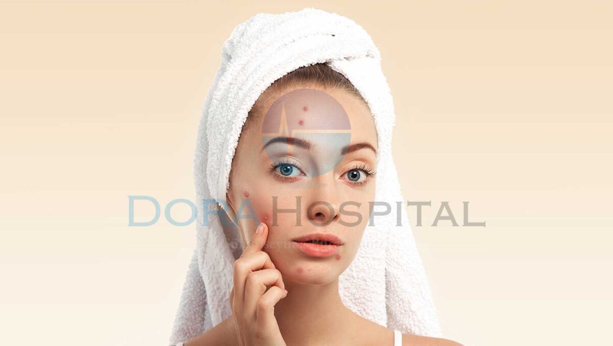 Sivilce ve Akne Tedavisi