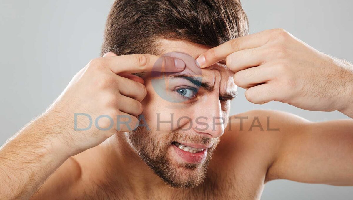 Deri Kistlerinin Alınması