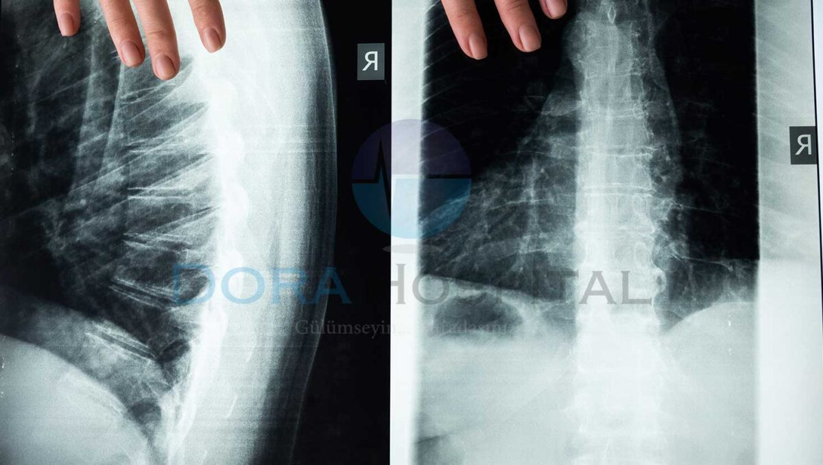 Omurga Stres Kırığı